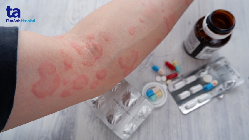 Mày Đay Do Áp Lực: Căn Bệnh Âm Thầm Gây Khó Chịu Lâu Dài 8 điều trị mày đay