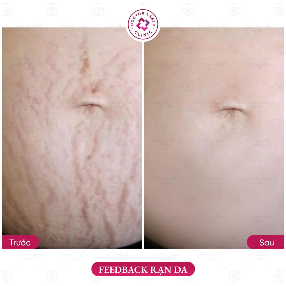 Kết quả sau điều trị rạn da bằng laser và vi điểm
