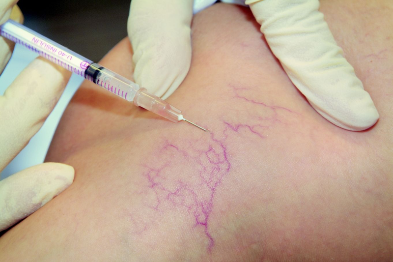 Laser mạch máu: Giải pháp hiệu quả cho giãn mao mạch và da đỏ 8 Chăm sóc da sau laser mạch máu