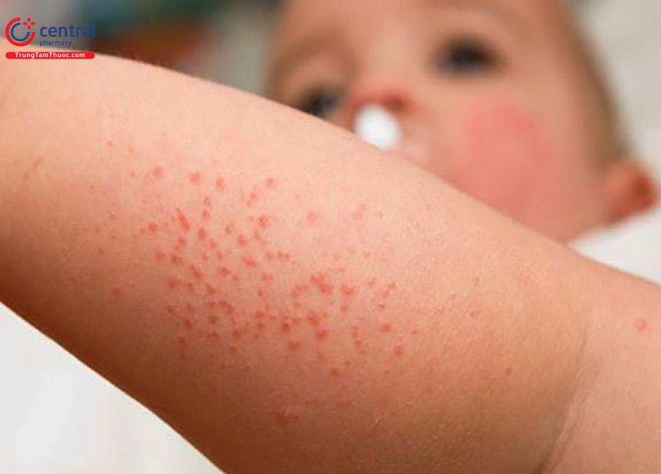 Điều trị thiếu máu tan máu tự miễn