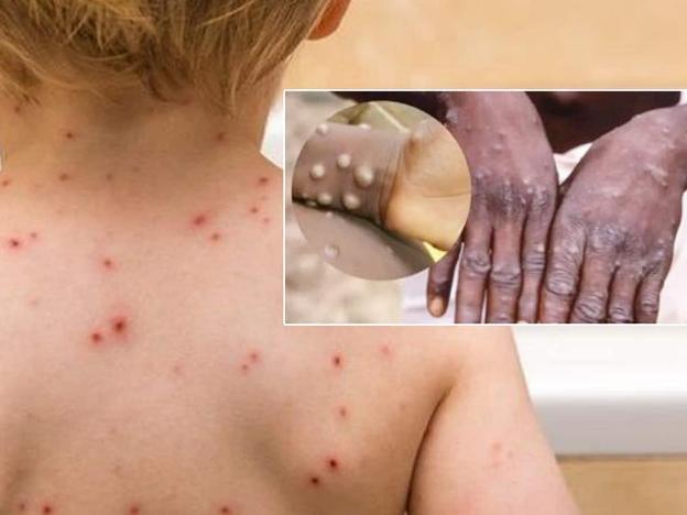 Virus gây bệnh đậu mùa khỉ