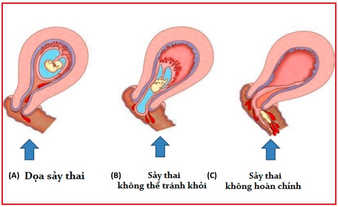 Dấu hiệu dọa sảy thai