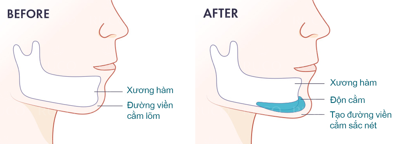 Sụn độn cằm Hoa Kỳ chính hãng