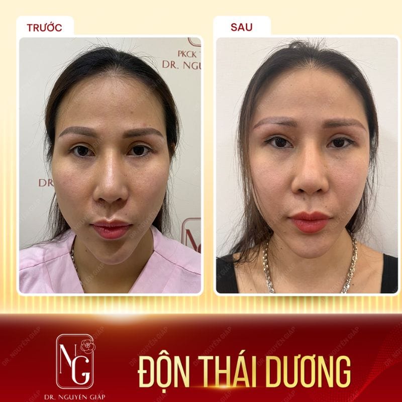 Độn thái dương cải thiện gương mặt hốc hác