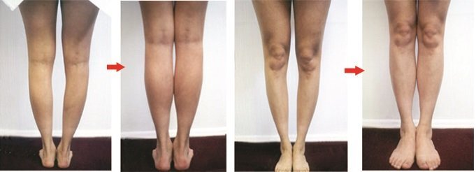 độn bắp chân giúp chân đầy đặn tự nhiên