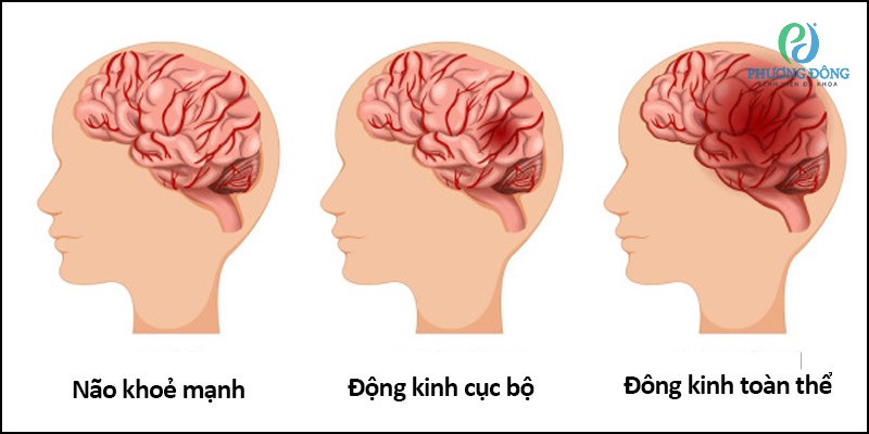 Sơ đồ cơ chế động kinh cục bộ