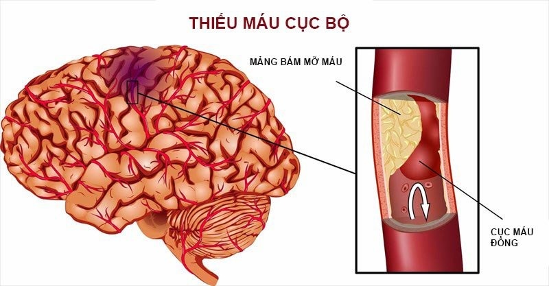 Đột quỵ thiếu máu não