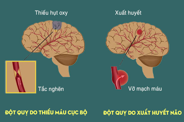 Nguyên nhân nhồi máu não