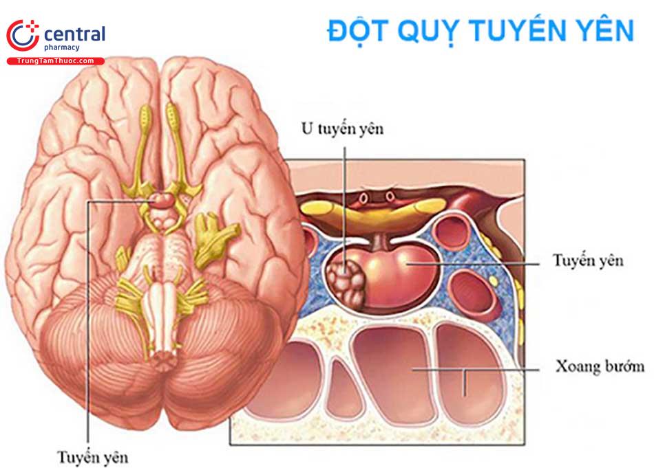 MRI u tuyến yên chảy máu