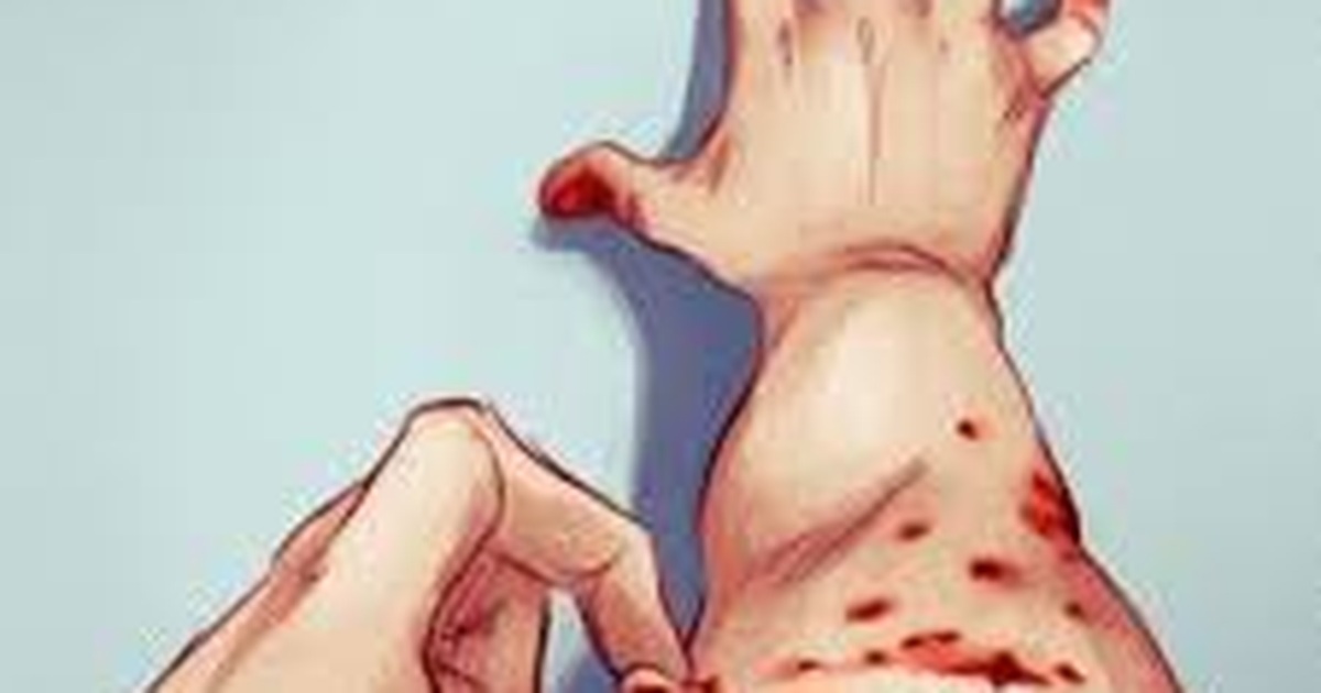 Hình ảnh người mắc tật cào da
