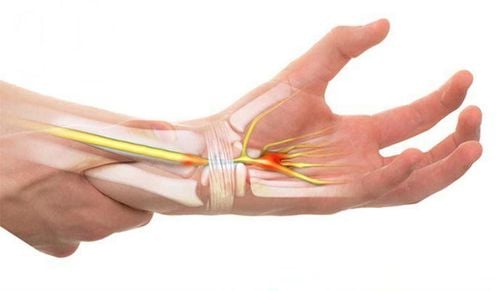 Tư thế làm việc sai gây hội chứng đường hầm cổ tay