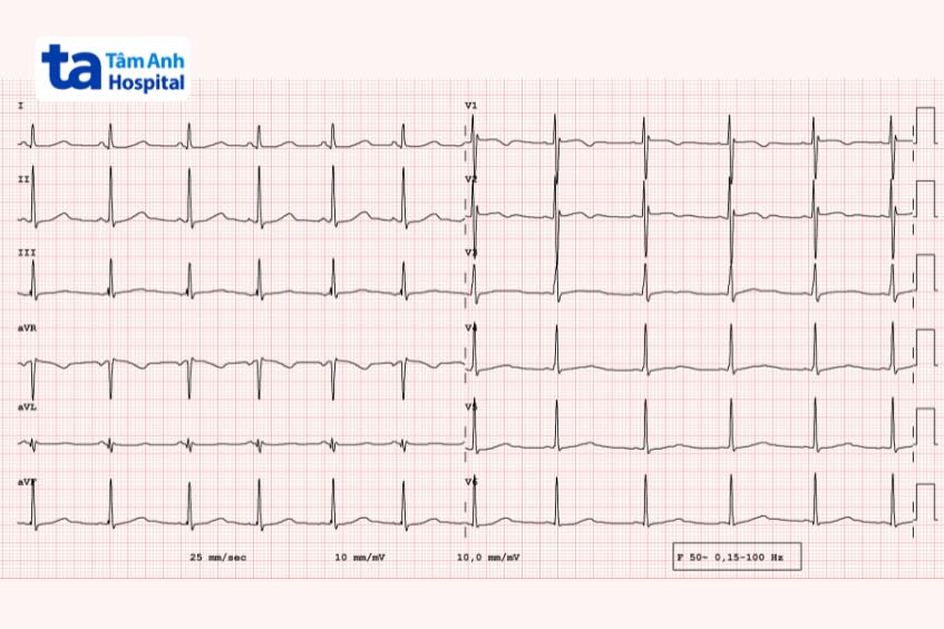 Hội chứng QT dài bẩm sinh: Nguyên nhân, triệu chứng và cách điều trị hiệu quả 8 ECG đo đoạn QT kéo dài