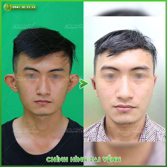 Kết quả chỉnh sửa tai vểnh