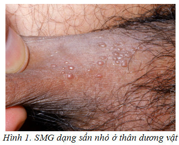 Sùi mào gà ở nam