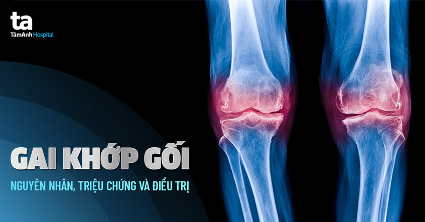 Hình ảnh mô phỏng gai khớp gối