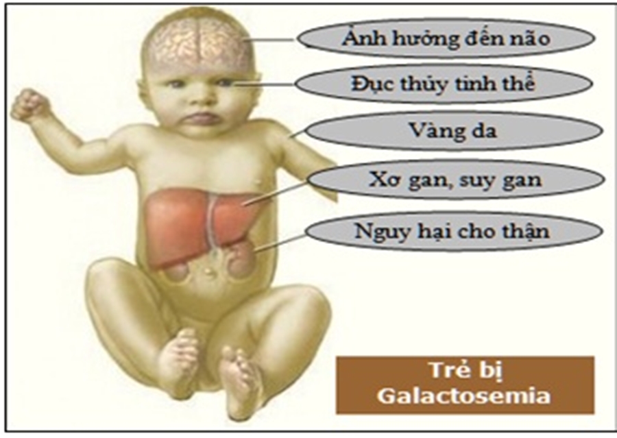 Trẻ sơ sinh mắc Galactosemia được điều trị tại bệnh viện