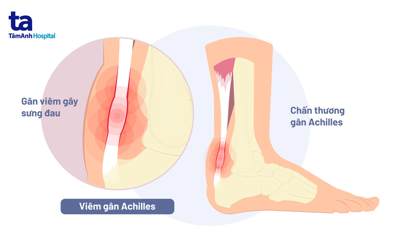 Viêm gân Achilles