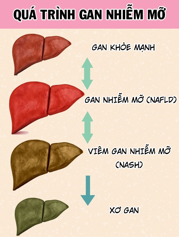 Hình ảnh gan nhiễm mỡ cấp tính thai kỳ