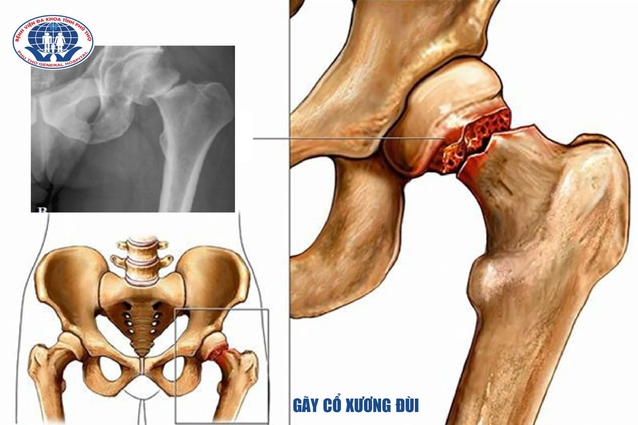 Gãy cổ xương đùi: Nguyên nhân, dấu hiệu và cách điều trị hiệu quả 7 Gãy cổ xương đùi là gì