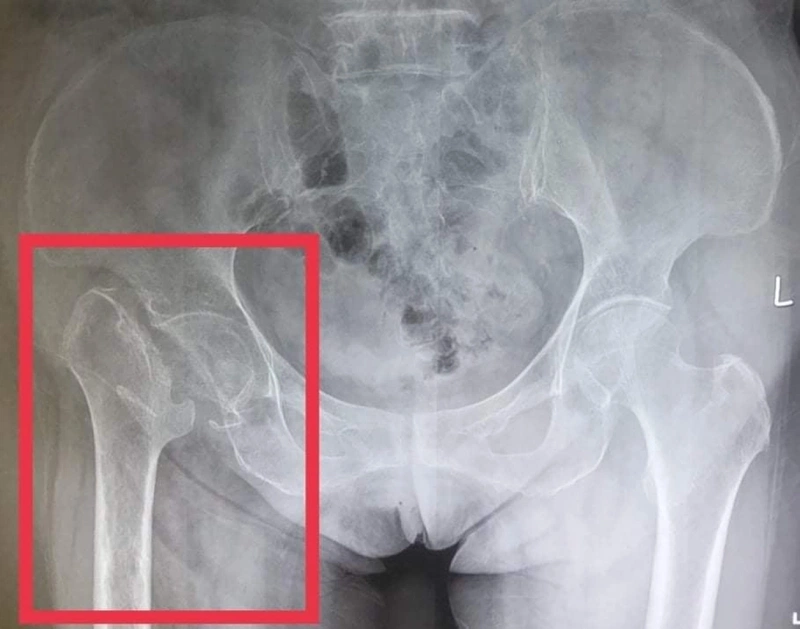 Gãy cổ xương đùi: Nguyên nhân, dấu hiệu và cách điều trị hiệu quả 8 Phân loại gãy cổ xương đùi
