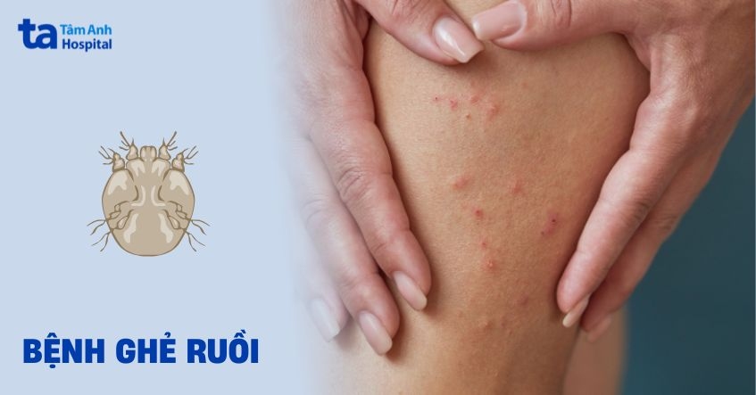 Cách điều trị bệnh ghẻ