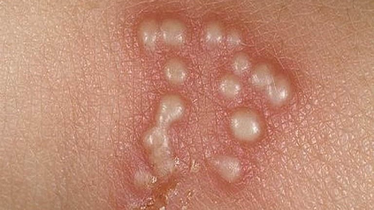 Điều trị ghẻ phỏng ở trẻ em