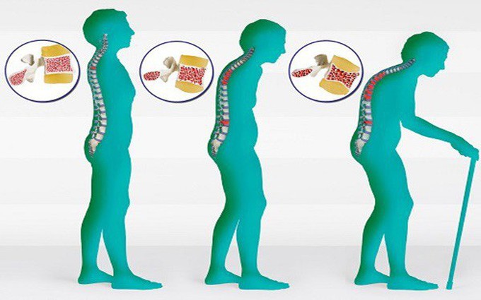 Người cao tuổi bị giảm chiều cao
