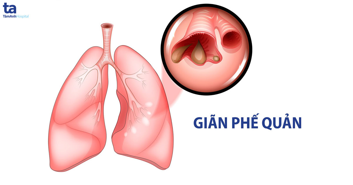 CT scan giãn phế quản