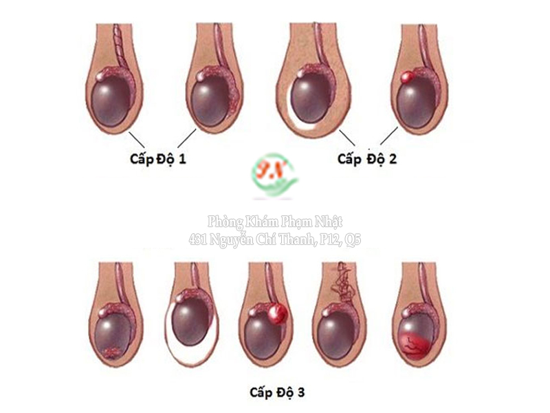 Hình ảnh giãn tĩnh mạch thừng tinh theo cấp độ