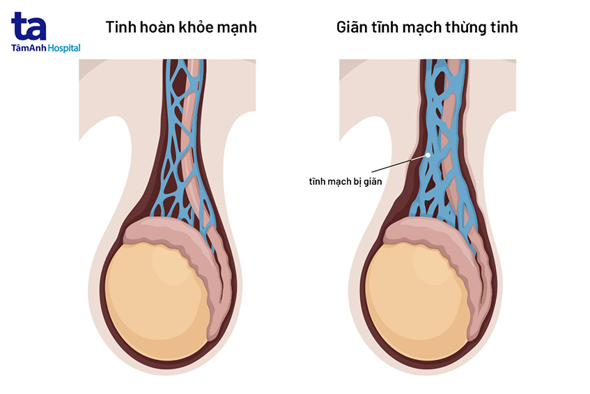Giãn Tĩnh Mạch Thừng Tinh (Ở Nam): Nguyên Nhân, Triệu Chứng & Điều Trị 8 Triệu chứng giãn tĩnh mạch thừng tinh