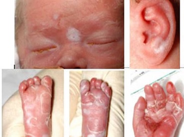 Phát ban lòng bàn tay ở trẻ giang mai bẩm sinh