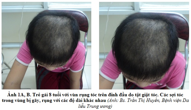 Triệu chứng tật giật tóc