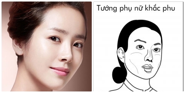 Gò má cao trước và sau phẫu thuật