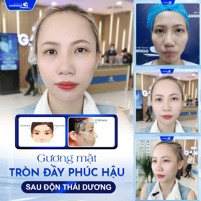 Gương mặt đầy đặn sau độn thái dương