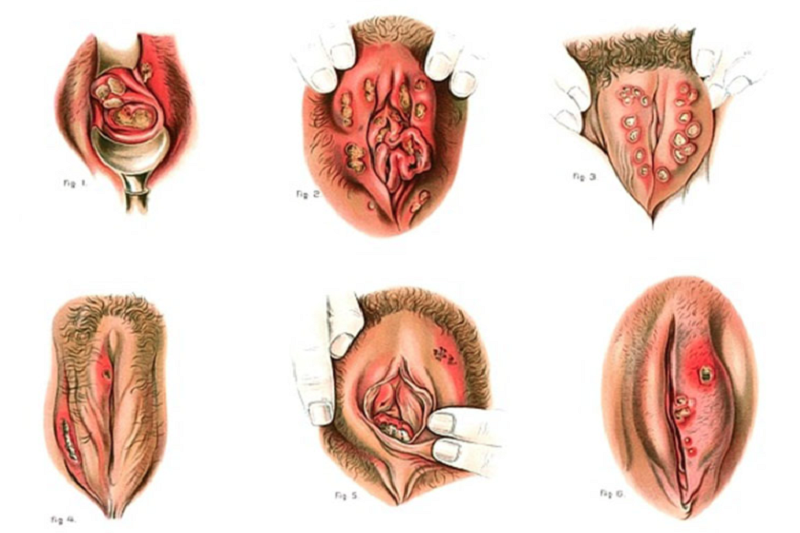 Vi khuẩn Haemophilus ducreyi