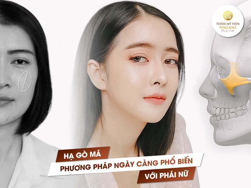 Phẫu thuật hạ gò má tại thẩm mỹ viện uy tín