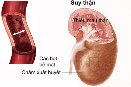 Hạ đường huyết do thuốc