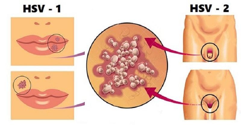 Herpes sinh dục là gì? Tổng quan về bệnh mụn rộp sinh dục 7 Hình ảnh mụn rộp sinh dục