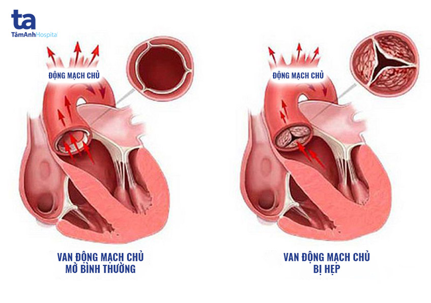 Hẹp van động mạch chủ là gì