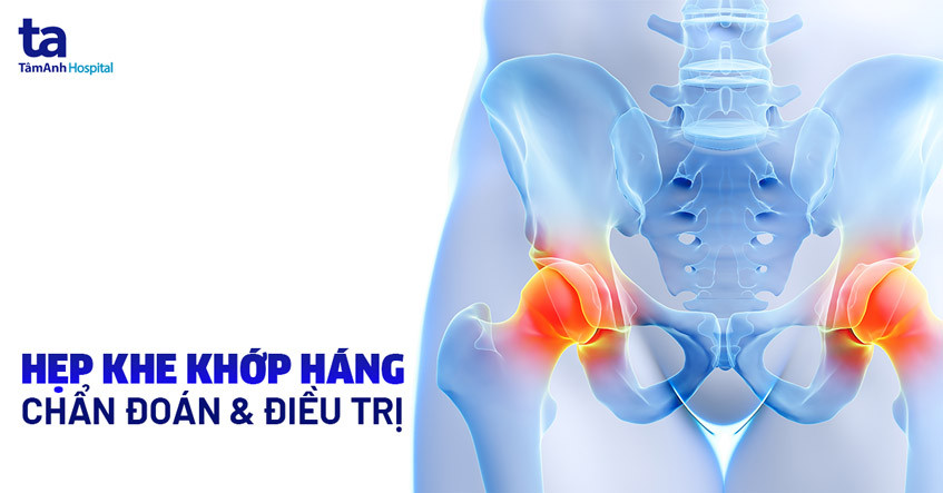 Hẹp khe khớp háng trên phim X-quang