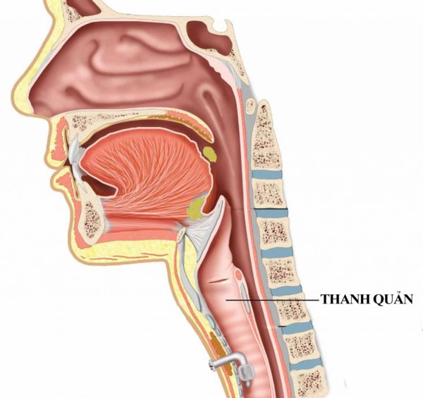 phân loại hẹp thanh quản