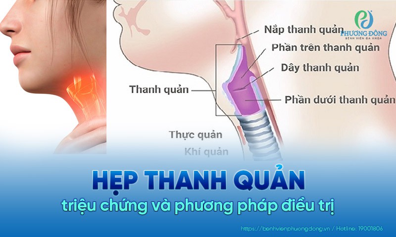 hẹp dưới thanh môn