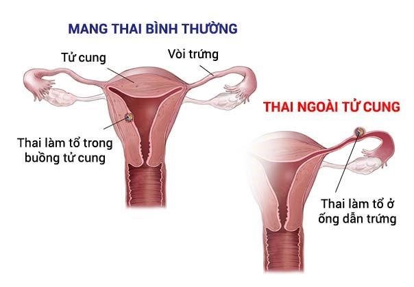 Hình ảnh siêu âm đầu dò thai ngoài tử cung