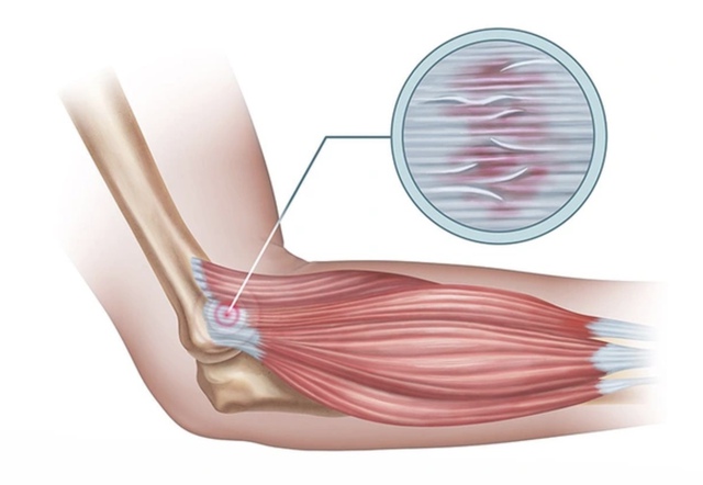 Nguyên nhân gây hội chứng golfer’s elbow