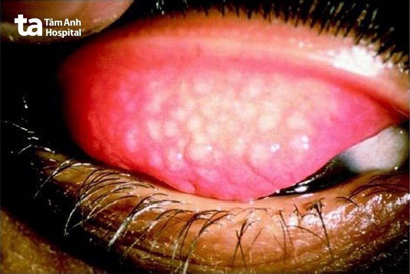 Hạt lympho kết mạc mắt hột