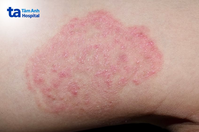 Hình ảnh bệnh nấm da Aspergillus