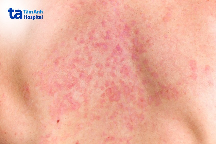 Hình ảnh tổn thương do nấm Candida ở da