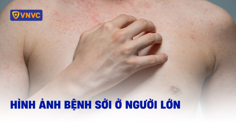 Phát ban dạng nhẹ ở người lớn
