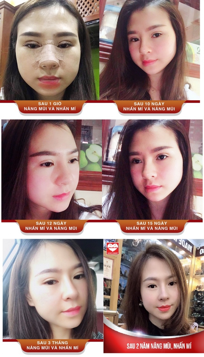 Nâng mũi bao lâu thì gom lại và đẹp tự nhiên? 8 Trải nghiệm thực tế sau nâng mũi