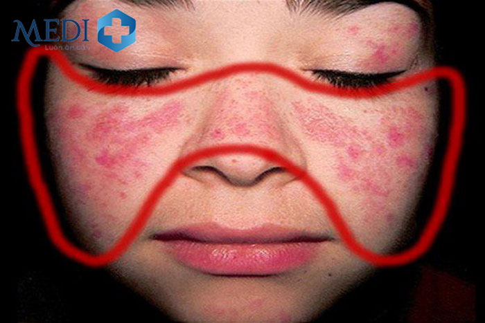 Ban cánh bướm trên mặt ở bệnh nhân lupus